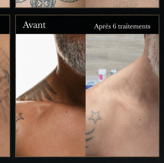 Zen'Art – Clinique dépilation laser, piercing et détatouage à Donnacona Clinique Zen'Art à Donnacona – services de laser et piercing