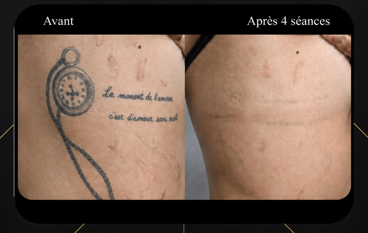 Zen'Art – Clinique dépilation laser, piercing et détatouage à Donnacona Clinique Zen'Art à Donnacona – services de laser et piercing