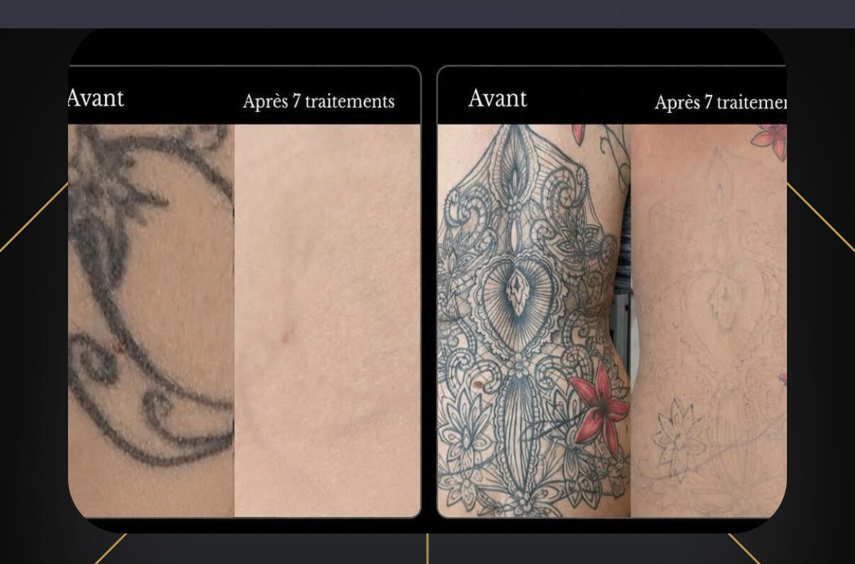 Zen'Art – Clinique dépilation laser, piercing et détatouage à Donnacona Clinique Zen'Art à Donnacona – services de laser et piercing